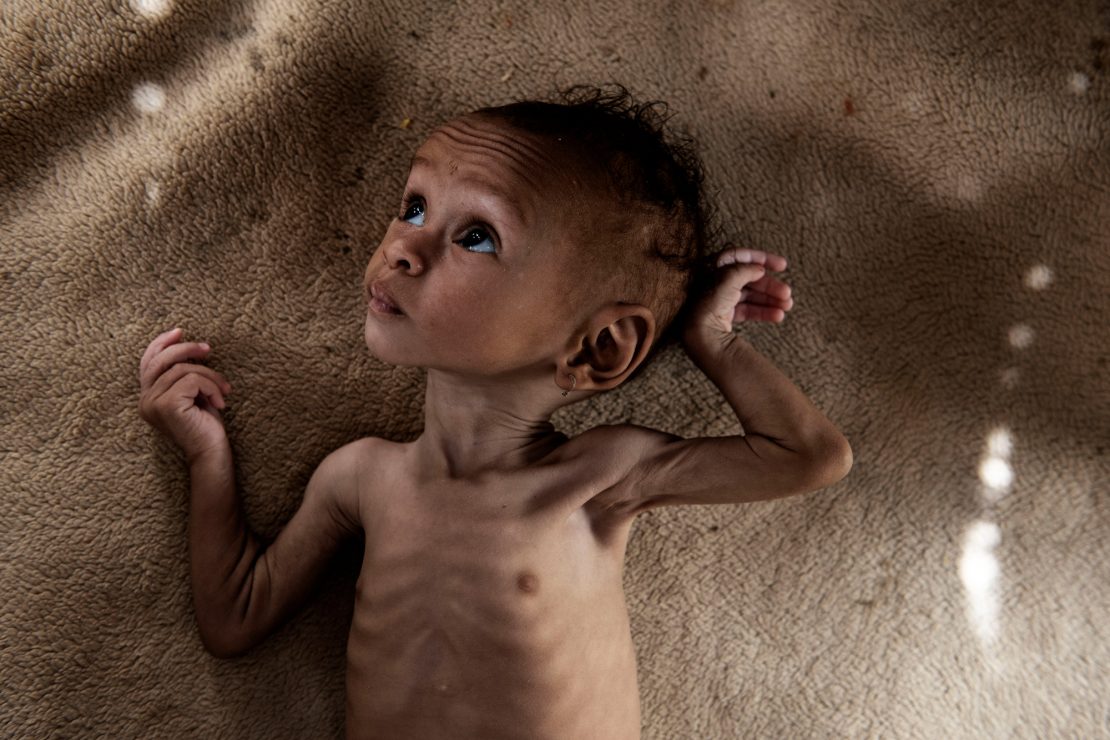 Yemen: hambre y ceguera
